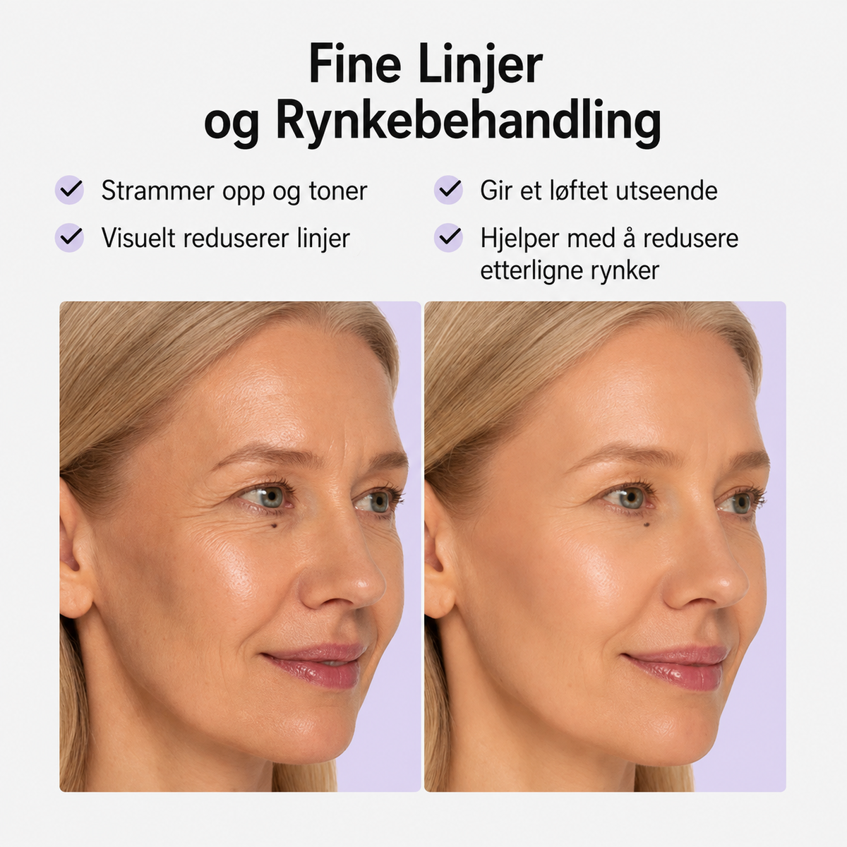 Anti-rynke plaster